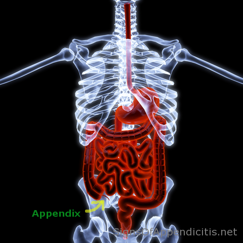 signs of appendicitis