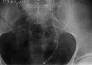 Stage 3 kidney disease x-ray photo