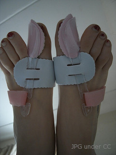 bunion correction