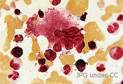 Low Platelets Causes