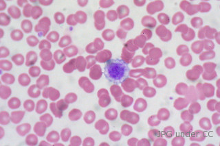 Low Platelets symptoms