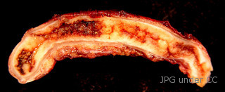 ruptured appendicitis icd 10