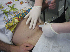 symptoms of appendicitis