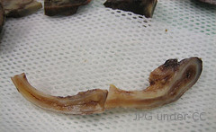 What is appendicitis