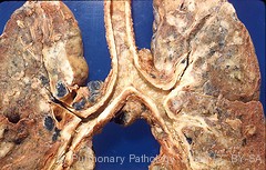 Non-Hodgkins lymphoma in lungs
