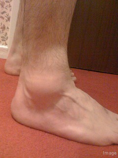 Dropsy Disease