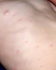Liver Damage Rash